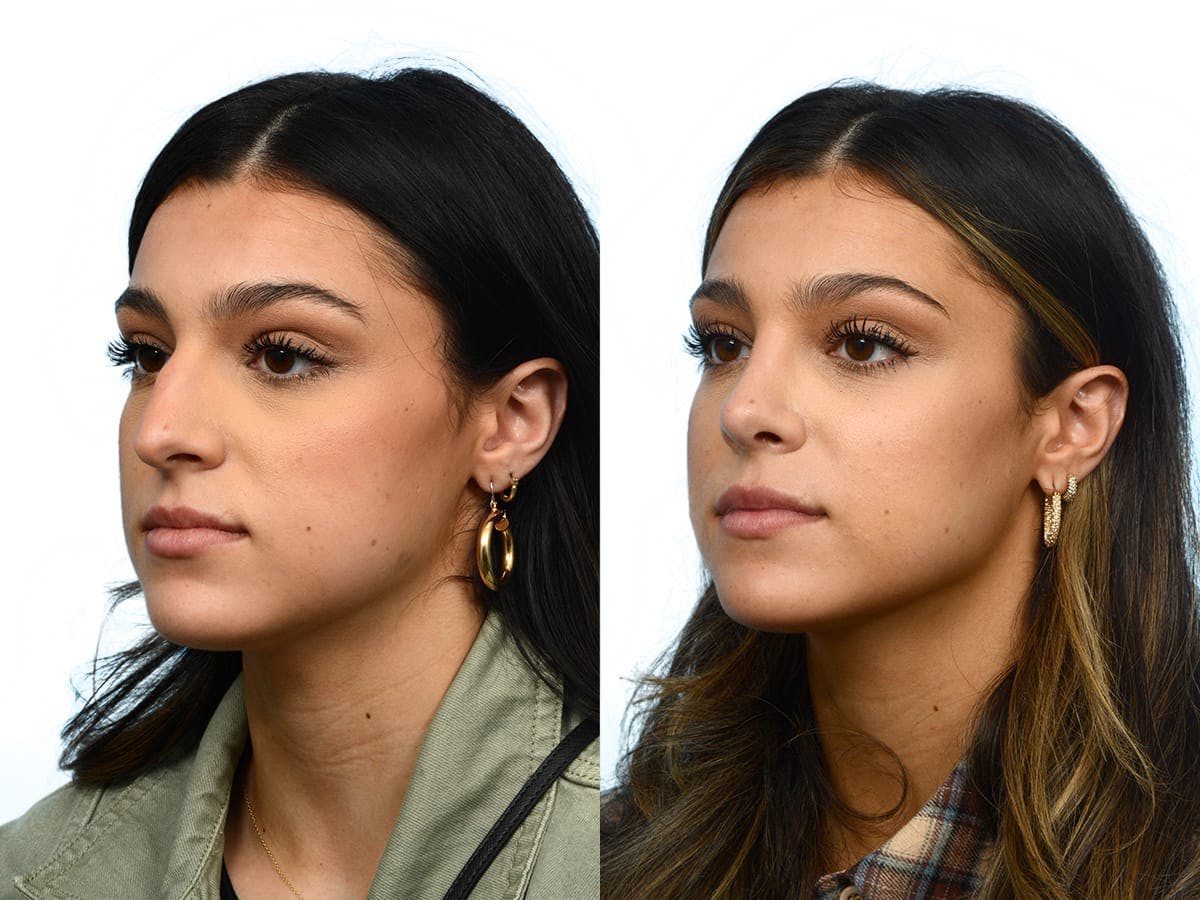 Rhinoplasty Before & After Gallery - Patient 395596 - Image 3