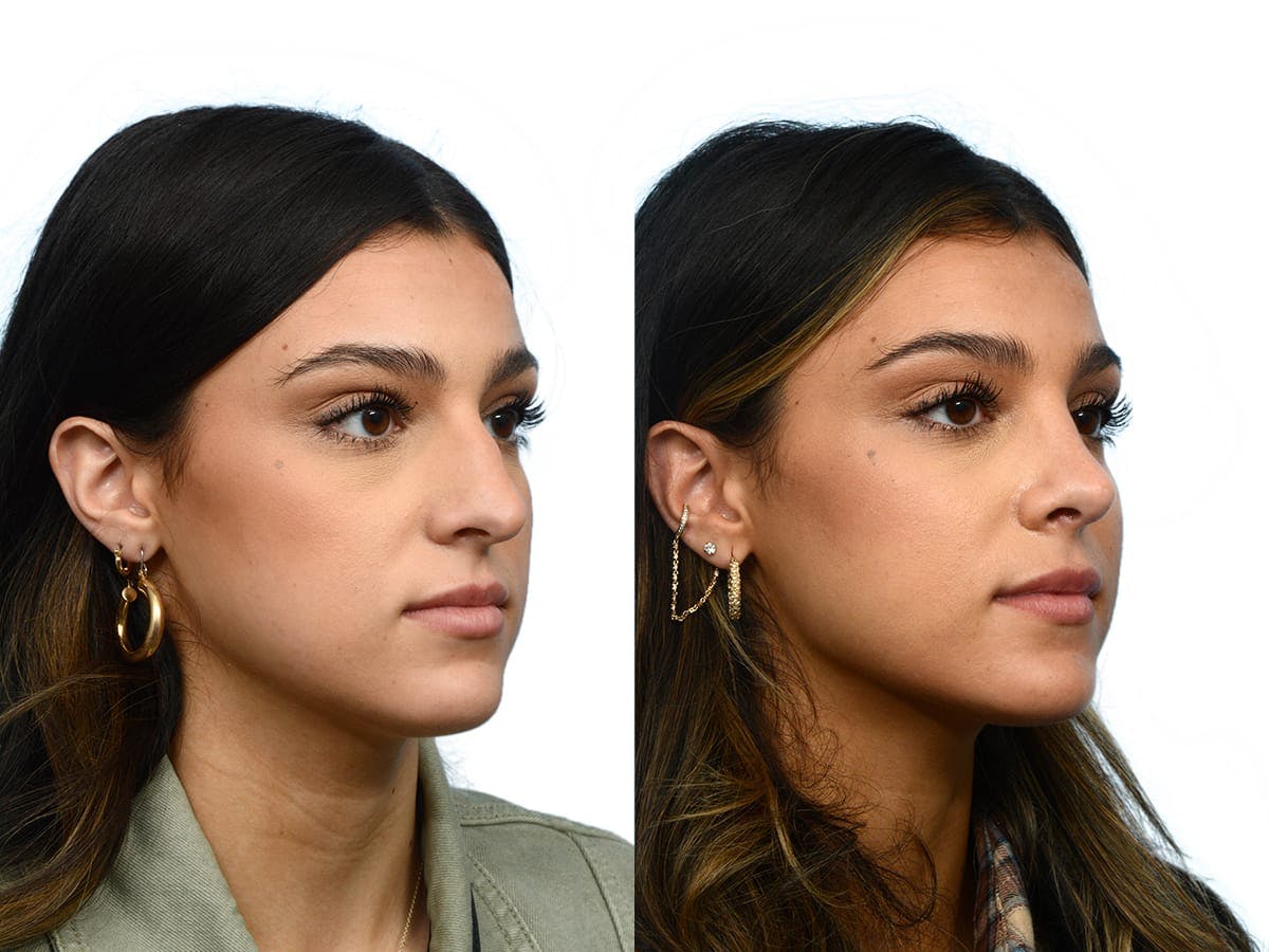 Rhinoplasty Before & After Gallery - Patient 395596 - Image 4