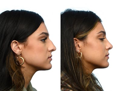 Rhinoplasty Before & After Gallery - Patient 395596 - Image 1