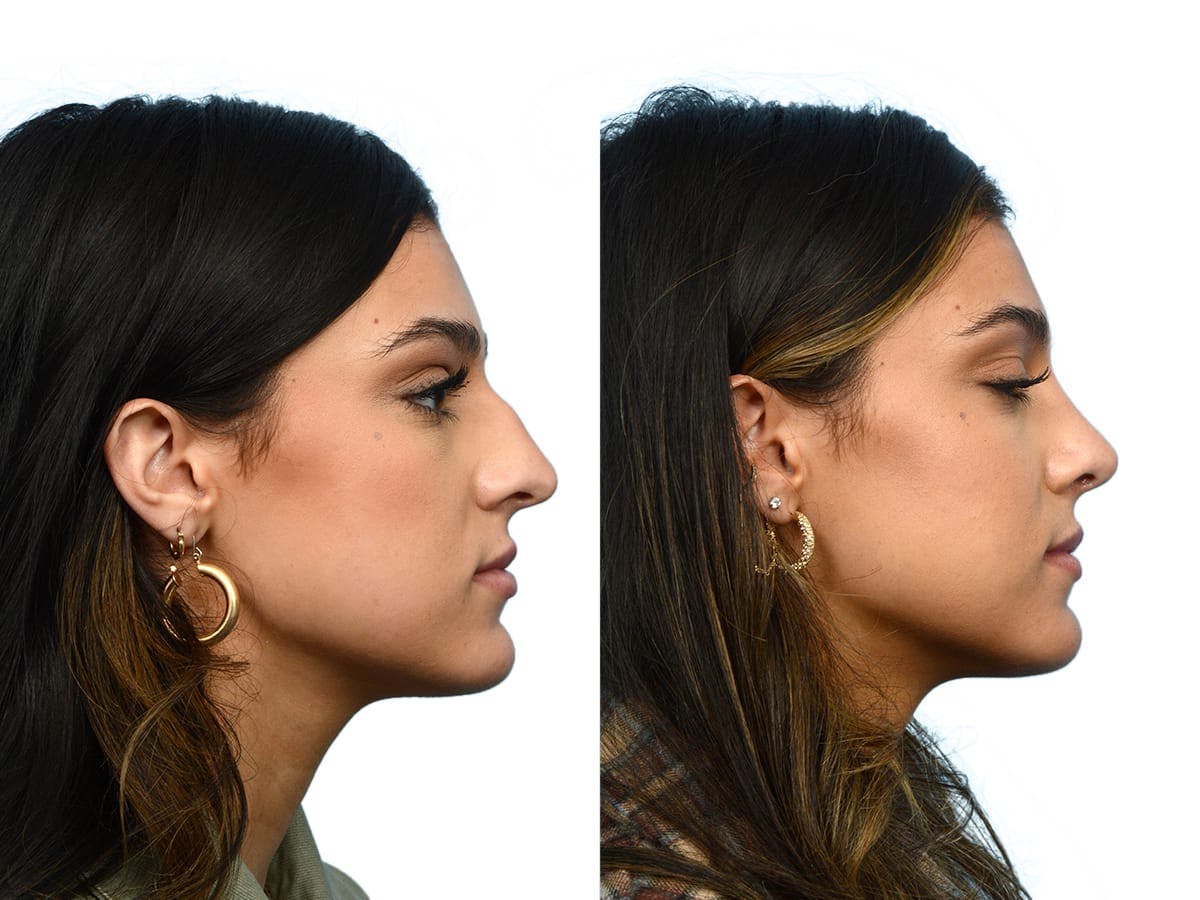 Rhinoplasty Before & After Gallery - Patient 395596 - Image 1