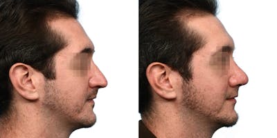 Rhinoplasty Before & After Gallery - Patient 215238 - Image 1