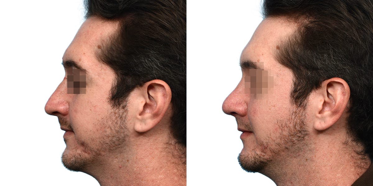 Rhinoplasty Before & After Gallery - Patient 215238 - Image 2