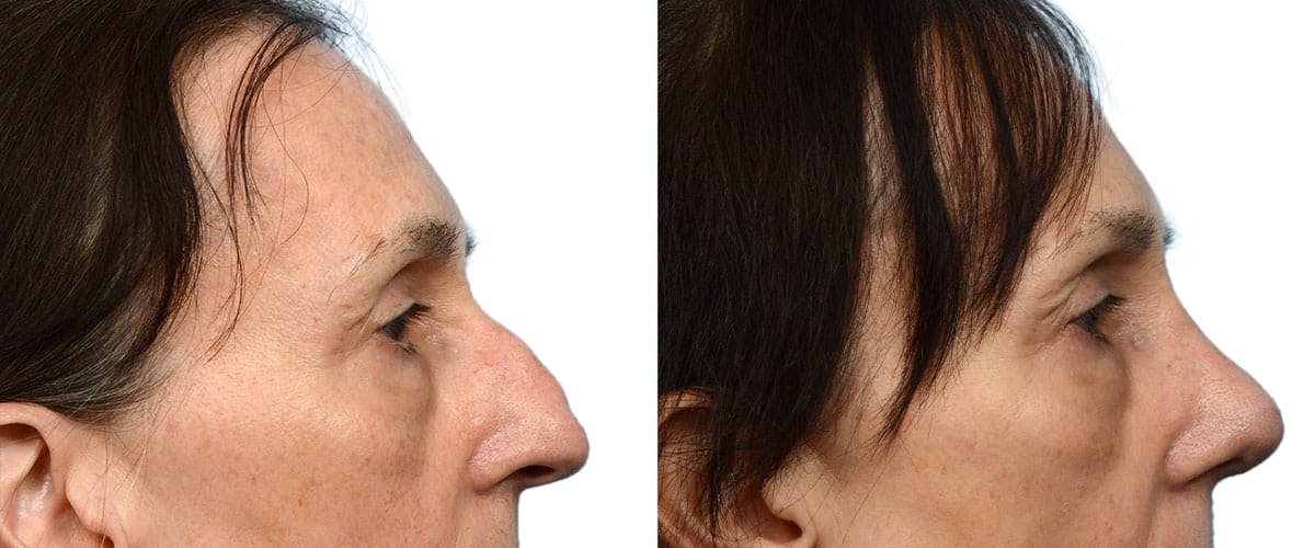 Rhinoplasty Before & After Gallery - Patient 224061 - Image 1