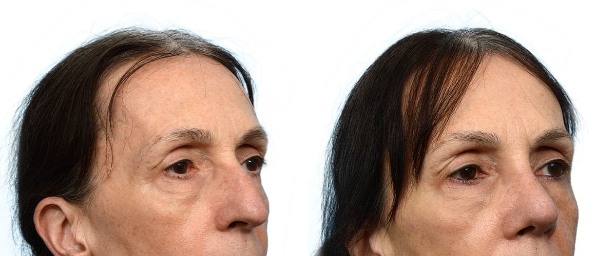 Rhinoplasty Before & After Gallery - Patient 224061 - Image 2