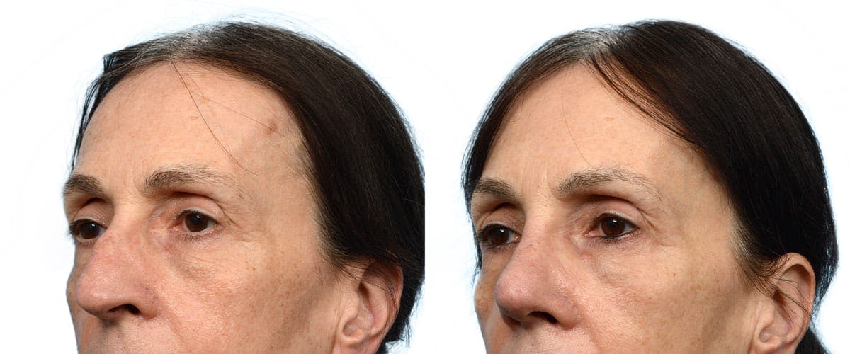 Rhinoplasty Before & After Gallery - Patient 224061 - Image 3