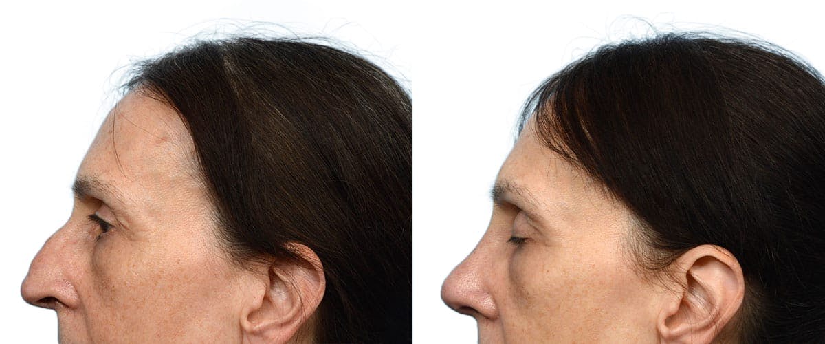 Rhinoplasty Before & After Gallery - Patient 224061 - Image 4