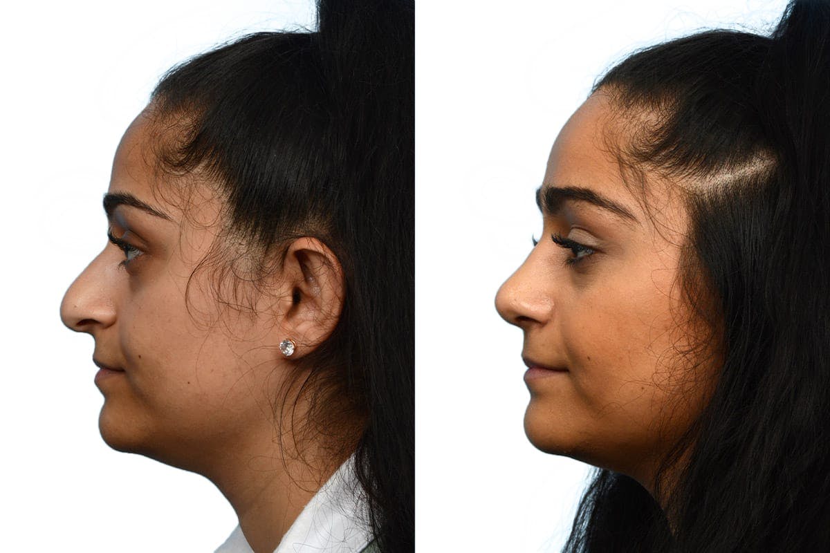 Rhinoplasty Before & After Gallery - Patient 174491 - Image 2
