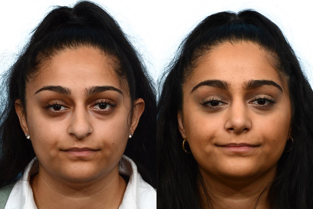 Rhinoplasty Before & After Gallery - Patient 174491 - Image 3