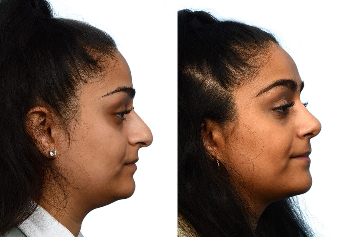 Rhinoplasty Before & After Gallery - Patient 174491 - Image 1