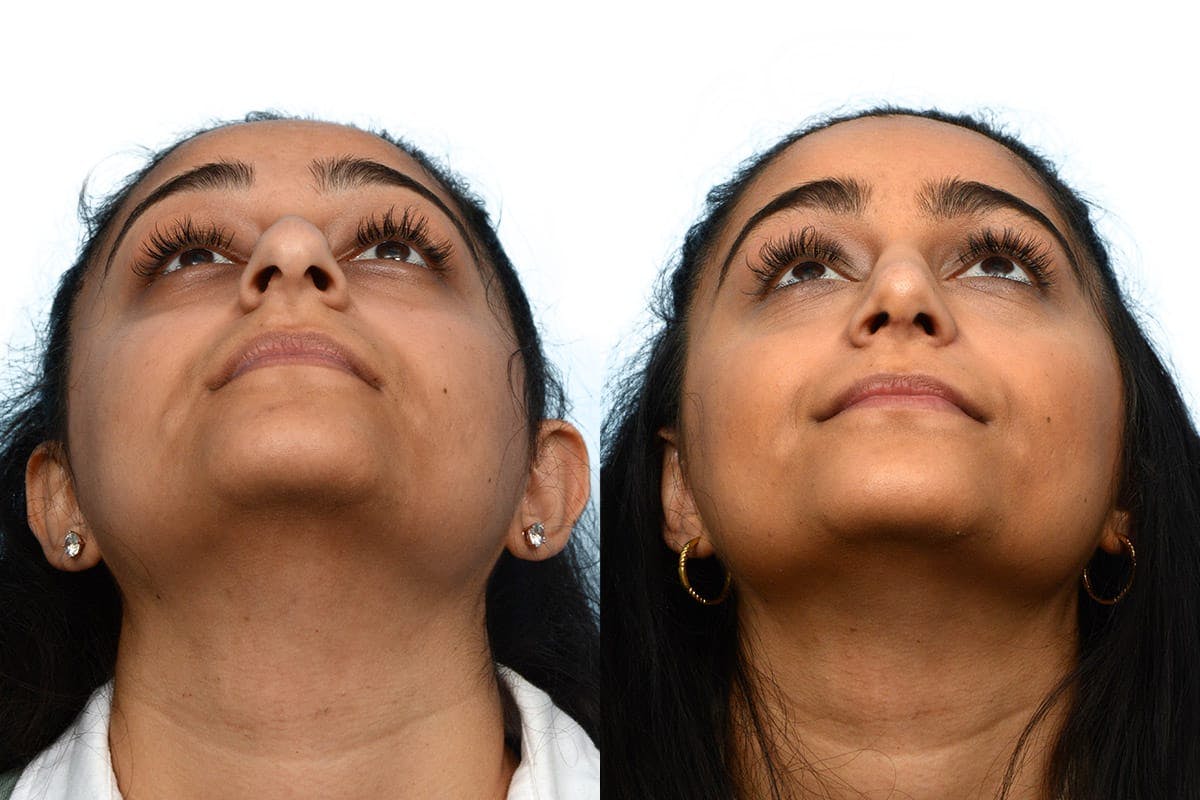 Rhinoplasty Before & After Gallery - Patient 174491 - Image 4
