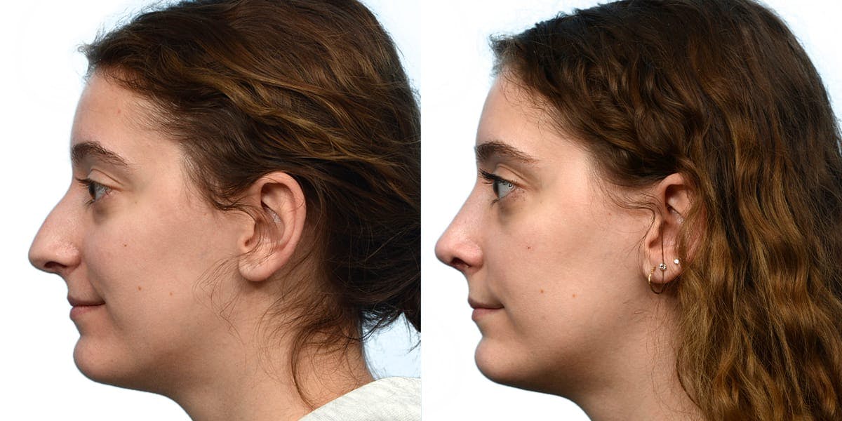 Rhinoplasty Before & After Gallery - Patient 111093 - Image 2