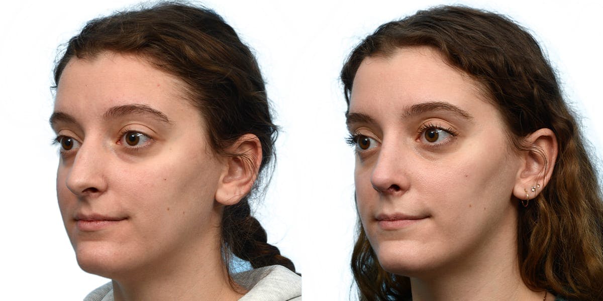 Rhinoplasty Before & After Gallery - Patient 111093 - Image 3