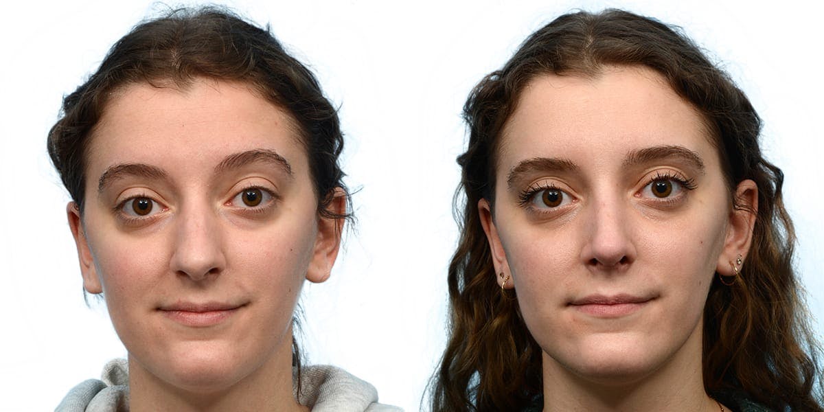 Rhinoplasty Before & After Gallery - Patient 111093 - Image 4