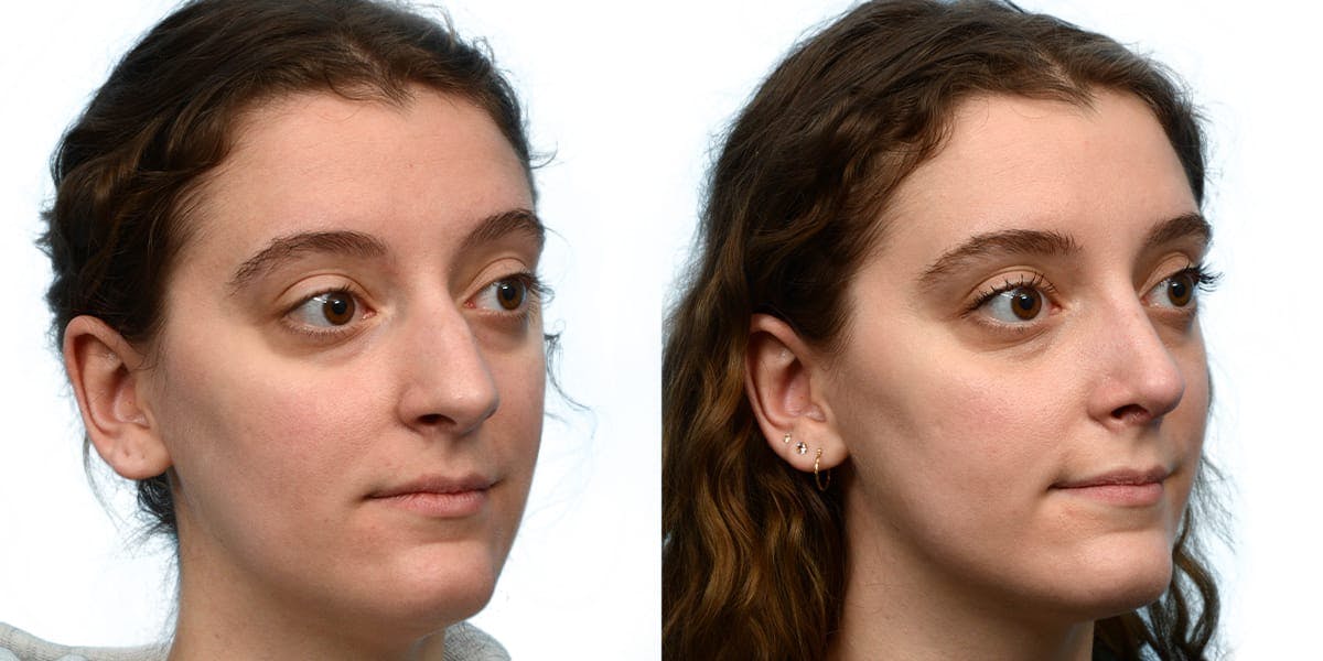 Rhinoplasty Before & After Gallery - Patient 111093 - Image 5