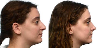 Rhinoplasty Before & After Gallery - Patient 111093 - Image 1