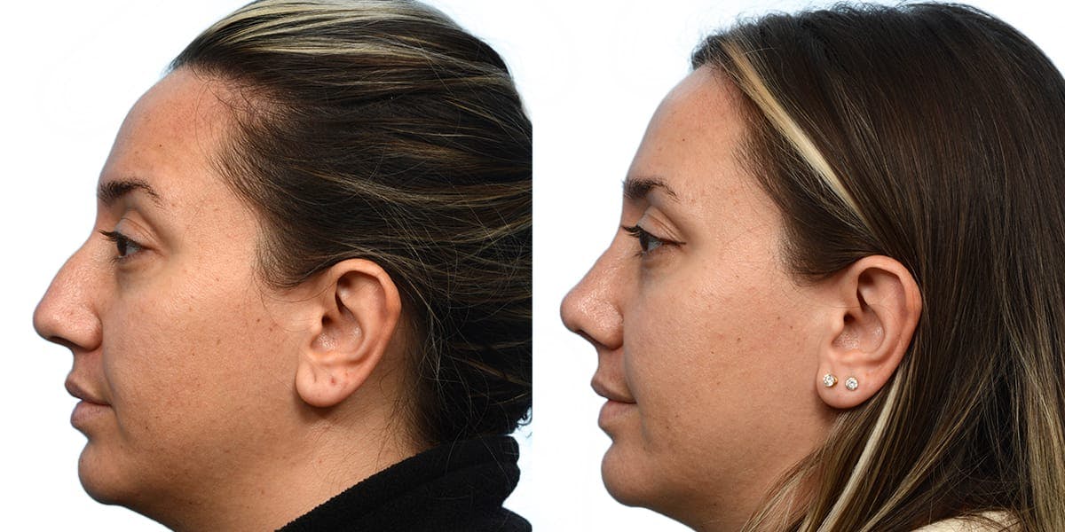 Rhinoplasty Before & After Gallery - Patient 344120 - Image 2