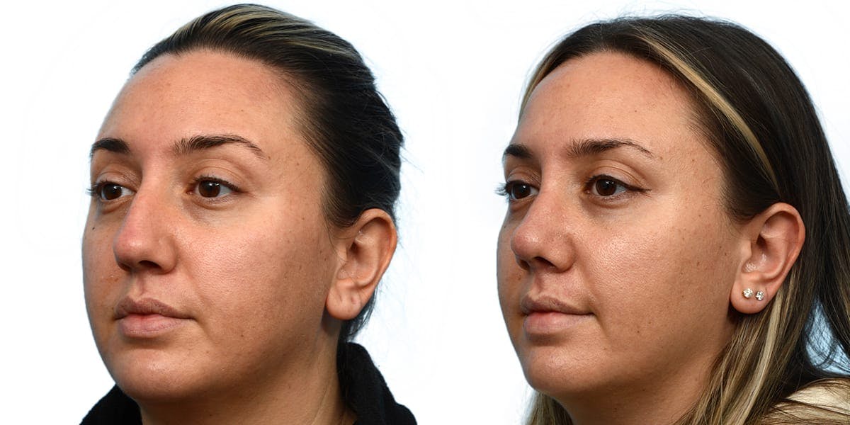 Rhinoplasty Before & After Gallery - Patient 344120 - Image 3