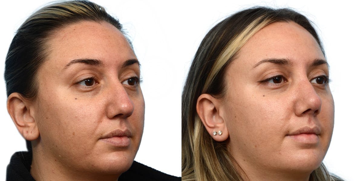 Rhinoplasty Before & After Gallery - Patient 344120 - Image 4