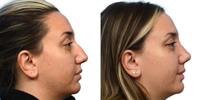 Rhinoplasty Before & After Gallery - Patient 344120 - Image 1