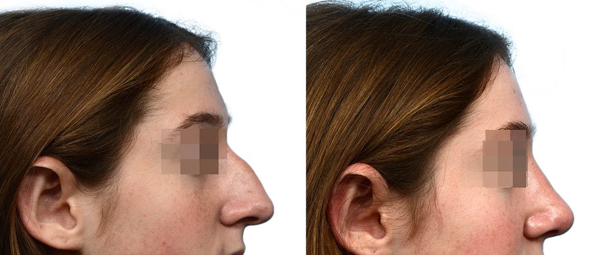 Rhinoplasty Before & After Gallery - Patient 941830 - Image 1