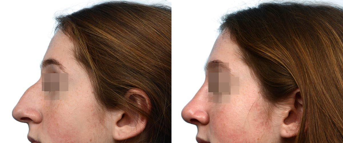 Rhinoplasty Before & After Gallery - Patient 941830 - Image 2