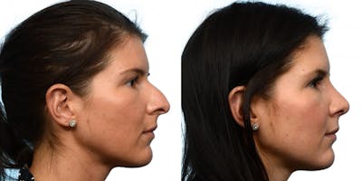 Rhinoplasty Before & After Gallery - Patient 945786 - Image 1