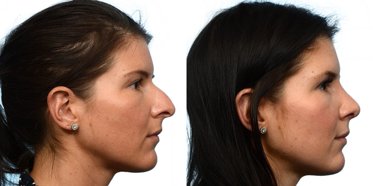 Rhinoplasty Before & After Gallery - Patient 945786 - Image 1