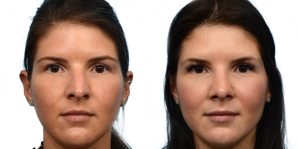 Rhinoplasty Before & After Gallery - Patient 945786 - Image 2