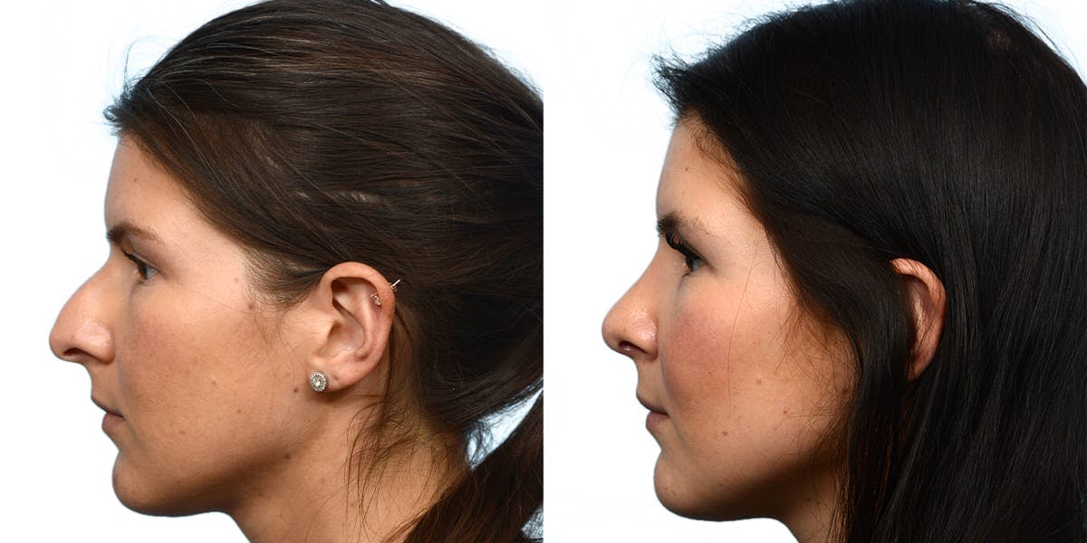 Rhinoplasty Before & After Gallery - Patient 945786 - Image 3