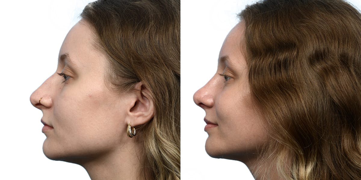 Rhinoplasty Before & After Gallery - Patient 284170 - Image 2