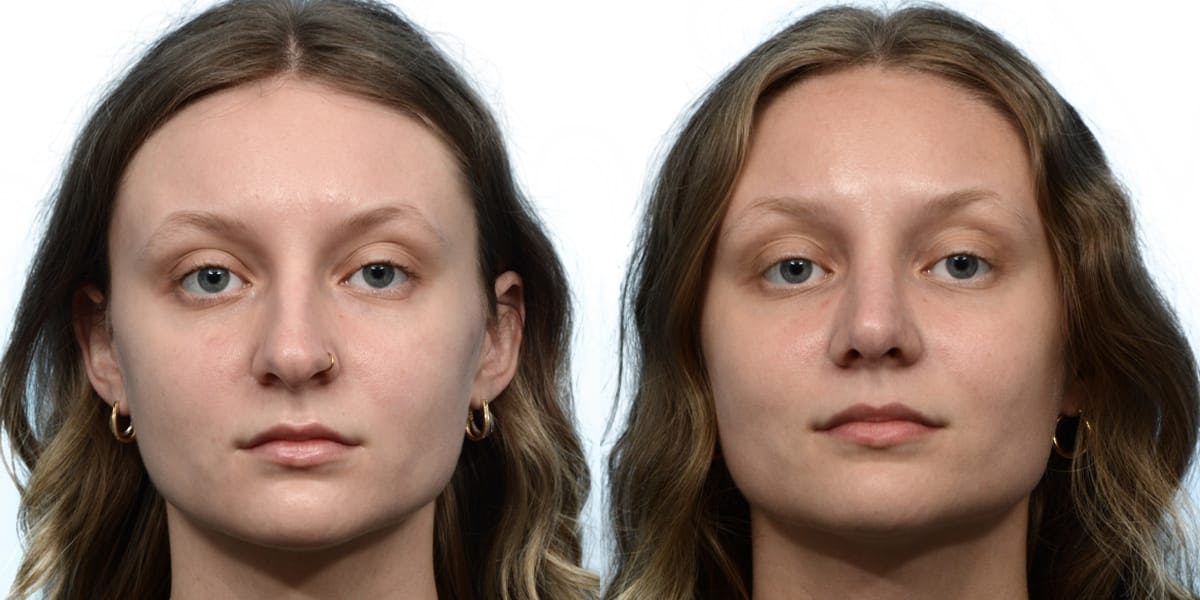 Rhinoplasty Before & After Gallery - Patient 284170 - Image 3