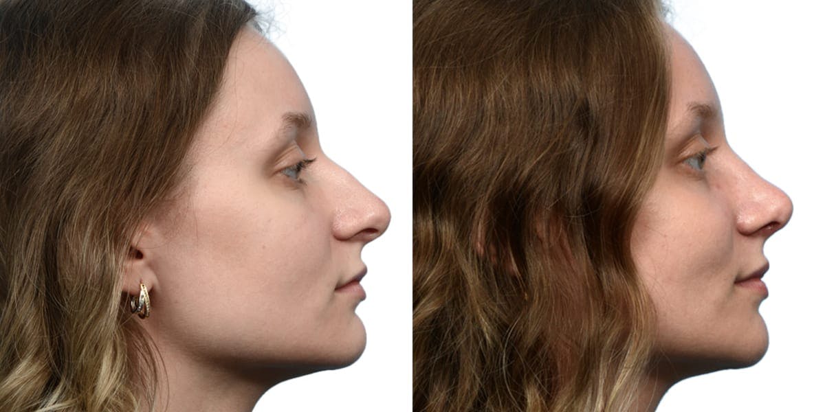 Rhinoplasty Before & After Gallery - Patient 284170 - Image 1