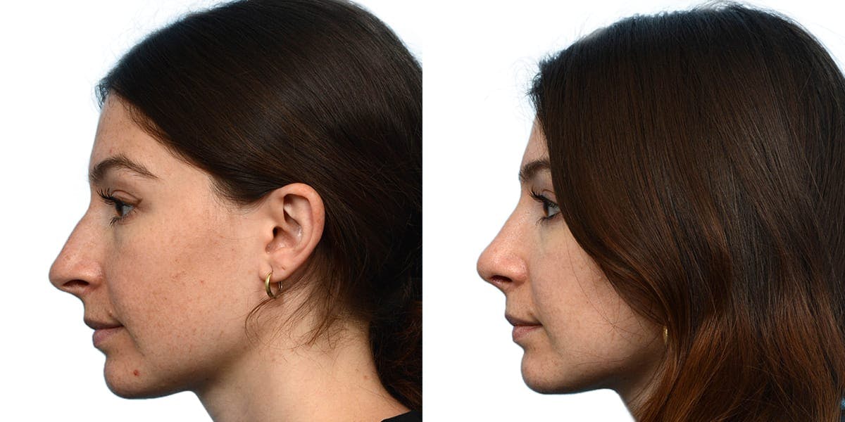 Rhinoplasty Before & After Gallery - Patient 376560 - Image 2
