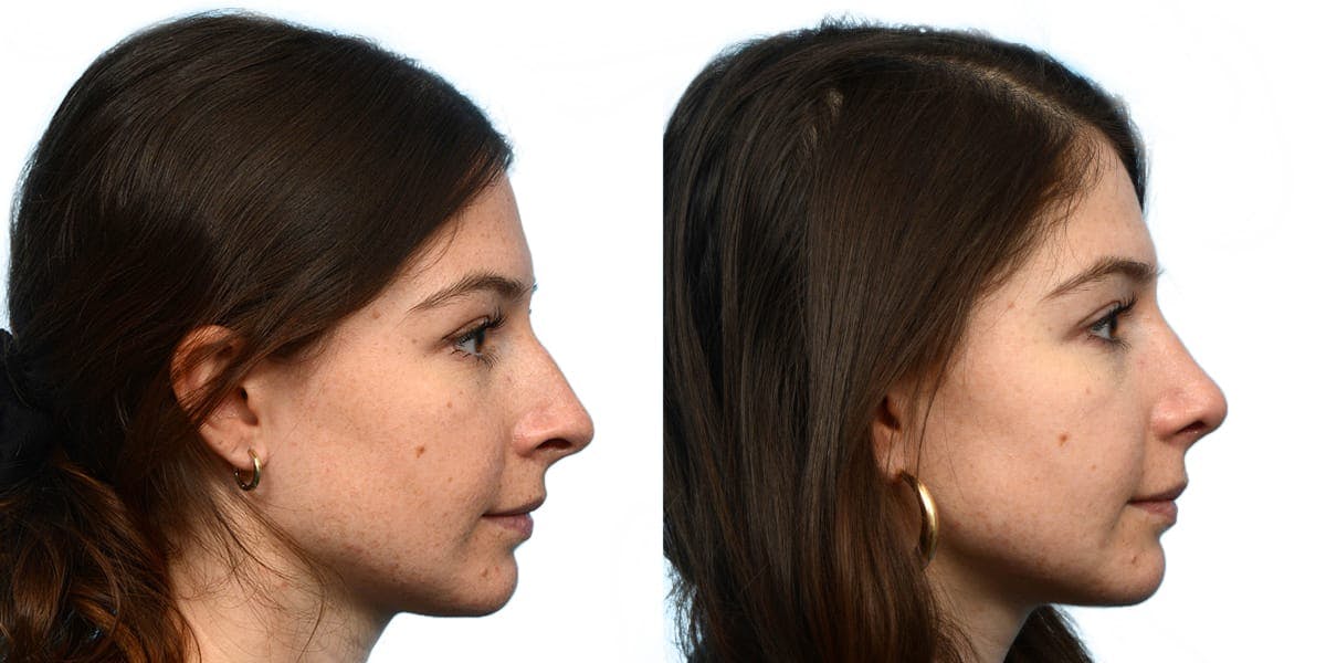 Rhinoplasty Before & After Gallery - Patient 376560 - Image 1