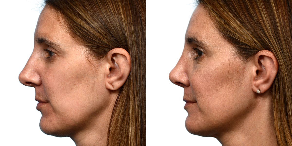 Rhinoplasty Before & After Gallery - Patient 150309 - Image 2