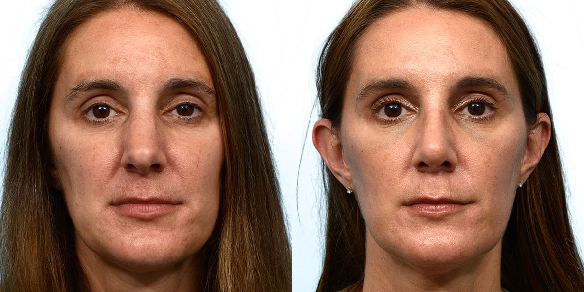 Rhinoplasty Before & After Gallery - Patient 150309 - Image 3