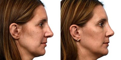 Rhinoplasty Before & After Gallery - Patient 150309 - Image 1