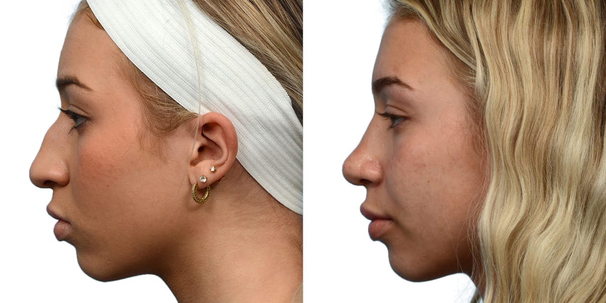 Rhinoplasty Before & After Gallery - Patient 135128 - Image 1