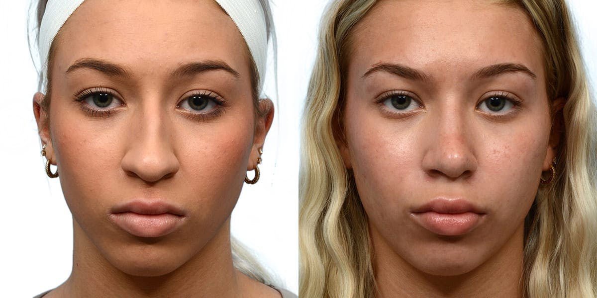 Rhinoplasty Before & After Gallery - Patient 135128 - Image 2