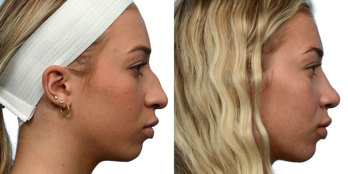 Rhinoplasty Before & After Gallery - Patient 135128 - Image 3
