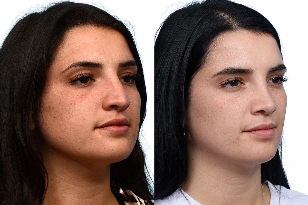 Rhinoplasty Before & After Gallery - Patient 158433 - Image 2