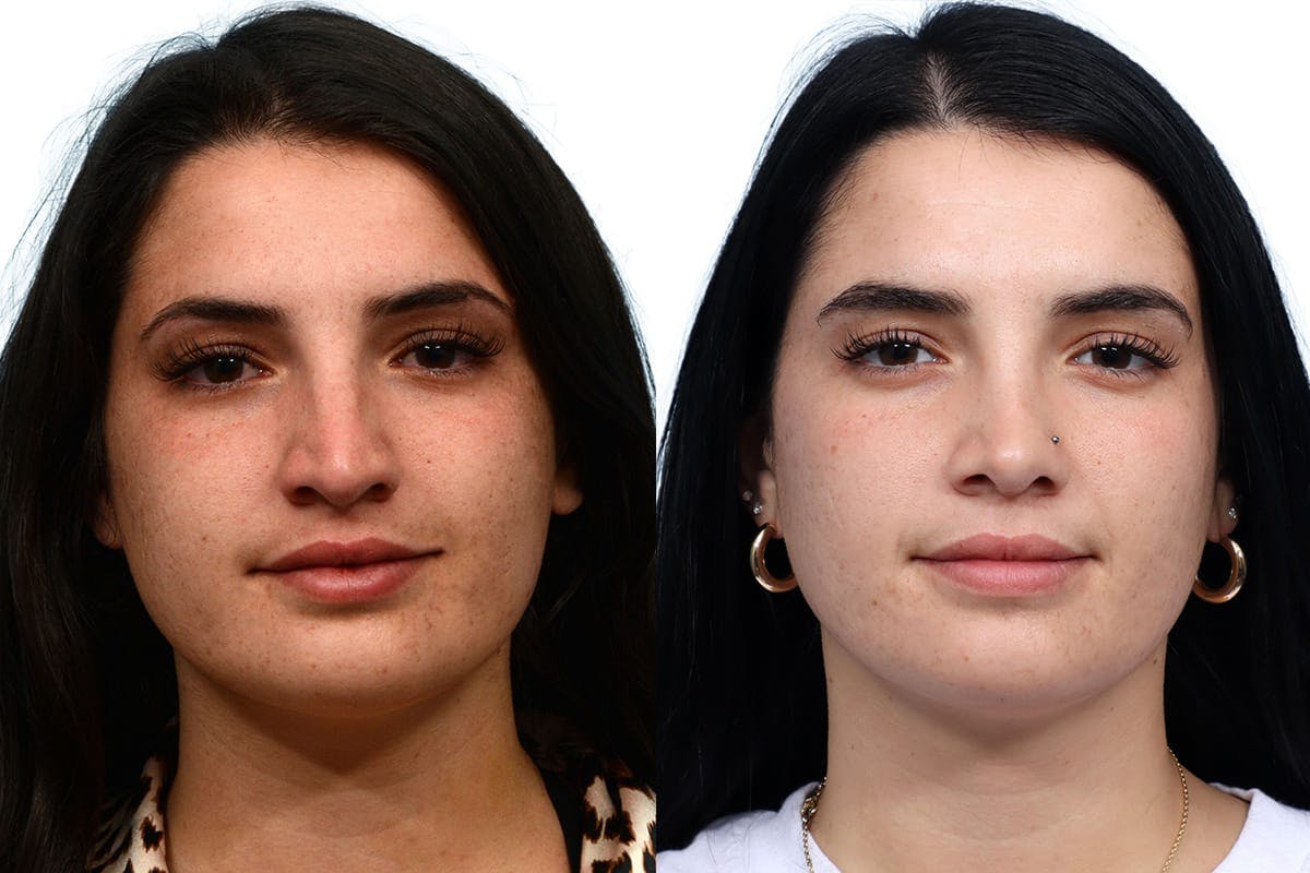 Rhinoplasty Before & After Gallery - Patient 158433 - Image 3