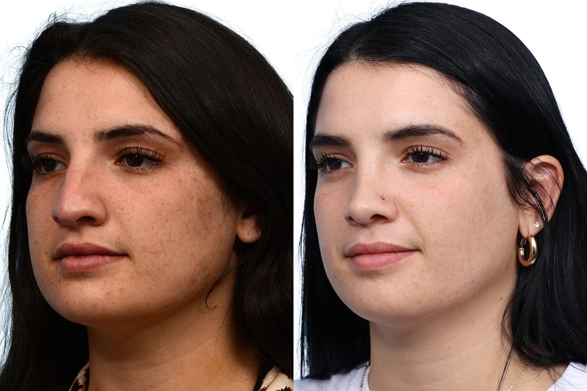 Rhinoplasty Before & After Gallery - Patient 158433 - Image 4