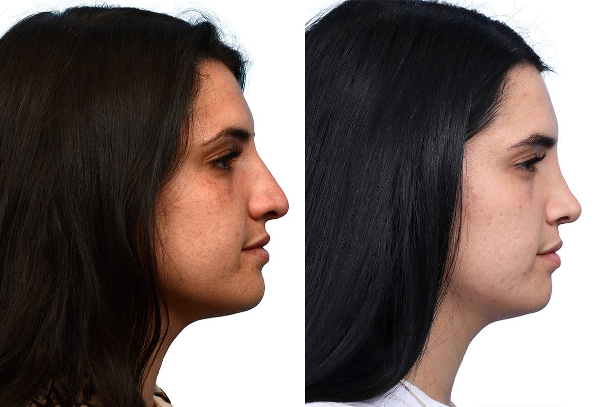 Rhinoplasty Before & After Gallery - Patient 158433 - Image 1