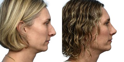 Rhinoplasty Before & After Gallery - Patient 335192 - Image 1