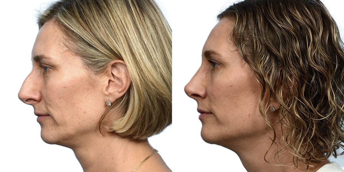 Rhinoplasty Before & After Gallery - Patient 335192 - Image 2