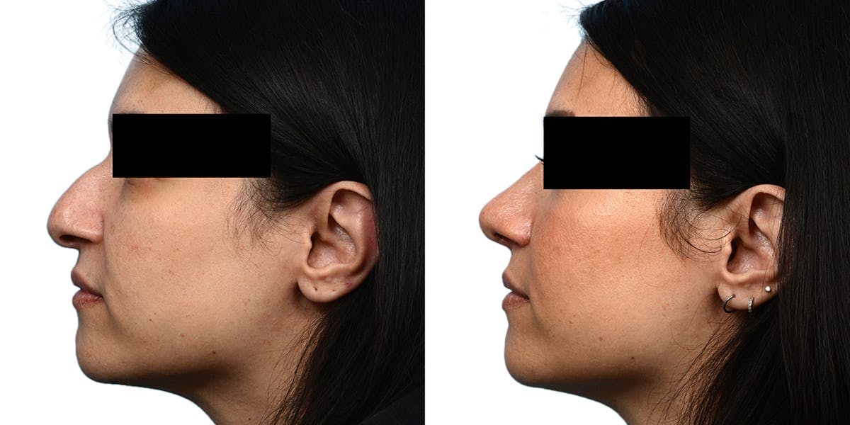 Rhinoplasty Before & After Gallery - Patient 230930 - Image 1
