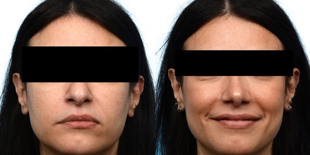 Rhinoplasty Before & After Gallery - Patient 230930 - Image 2