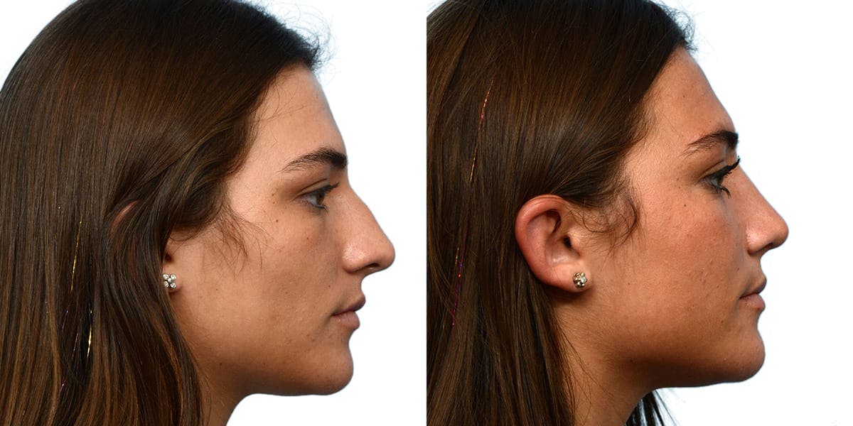 Rhinoplasty Before & After Gallery - Patient 206740 - Image 1