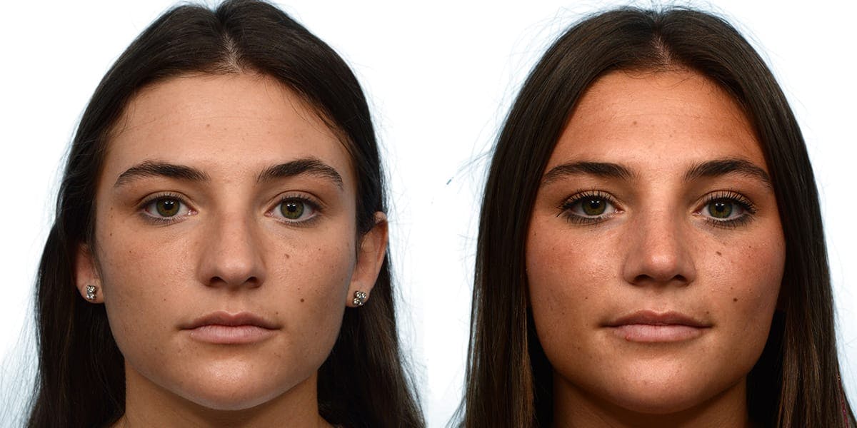 Rhinoplasty Before & After Gallery - Patient 206740 - Image 2